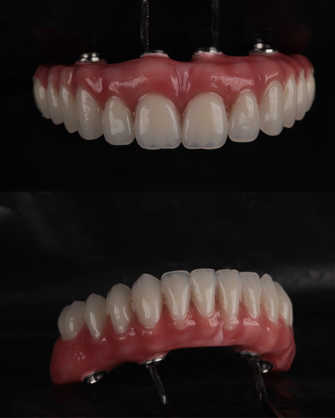 Prótese total sobre implantes tipo protocolo, vistas frontal e lateral