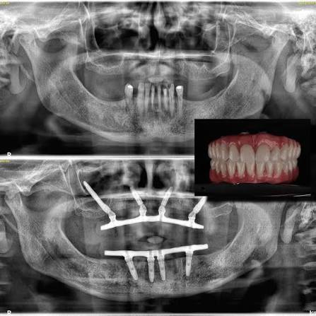 Radiografia panorâmica antes e depois de reabilitação com implantes