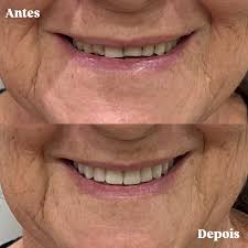 Antes e depois de reabilitação oral superior