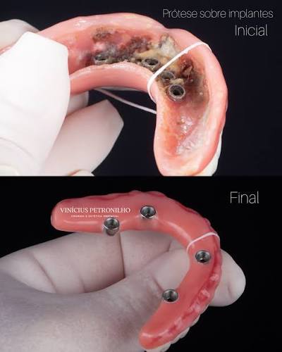 Prótese sobre implantes: situação inicial e prótese final finalizada